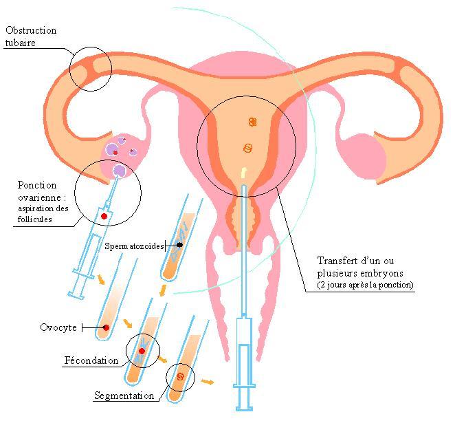 Fécondation in vitro : trente ans de bébés éprouvés